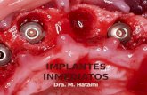 Implantes inmediatos