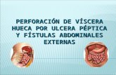 Perforacion de Viscera Hueca & Fistulas Abdominales