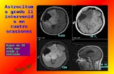 Astrocitoma grado II intervenido en cuatro ocasiones