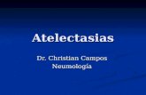 Atelectasias Dr. Christian Campos Neumología. Tipos Tipos Obstructiva Obstructiva Cicatrizal o fibrótica Cicatrizal o fibrótica Incremento de tejifo cicatrizal.