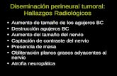 Diseminación perineural tumoral: Hallazgos Radiológicos Aumento de tamaño de los agujeros BC Destrucción agujeros BC Aumento del tamaño del nervio Captación.