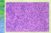 Forma Blástica Curso más agresivo Células con cromatina fina dispersa, nucleolos, mitosis, 51 /20hpf Núcleos de mayor tamaño Recuerda al linfoma linfoblástico.