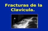 Fracturas de la Clavícula.. Fracturas de la Clavícula Frecuentes en el niño (30% de las fracturas) Caídas sobre la mano ++ Traumatismos directos sobre.
