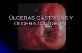 ÚLCERAS GÁSTRICAS Y ÚLCERA DUODENAL. DEFINICIÓN DE ÚLCERA Defecto de la mucosa gastrointestinal que se extiende a través de la muscular de la mucosa y.