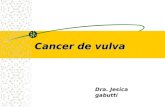 Cancer de vulva Dra. Jesica gabutti. Neoplasia intraepitelial de vulva Primera parte.