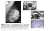 Caso 1: Mujer de 45 años asintomática, se realiza mamografía de cribado por antecedentes familiares de primer grado. Mamografía= mama densa con adenopatías.