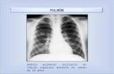 PULMÓN Nódulo pulmonar solitario en lóbulo superior derecho en varón de 16 años.