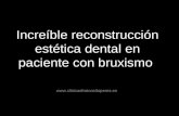 Reconstrucción estética dental completa en paciente con Bruxismo