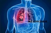 Generalidades de Neumonia y Neumonia Adquirida en la comunidad