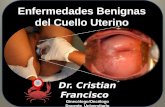 Enfermedades Benignas del Cuello Uterino Oct  2013