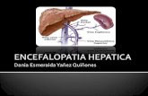 Encefalopatia hepatica