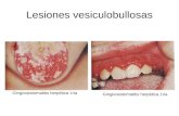 Lesiones Vesiculobullosas