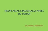 Neoplasias Malignas a Nivel de Torax
