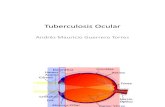 Tuberculosis Ocular
