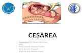 Indicaciones de Cesarea