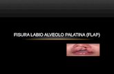 Fisura Labio Alveolo Palatina