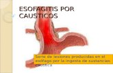 Esofagitis Por Causticos