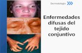 LE, Dermatomiosistis, Esclerodermia