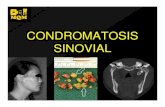 Condromatosis Sinovial
