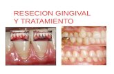 Resecion gingival