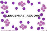C.2.Leucemias Agudas L&M