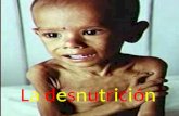 La desnutricion