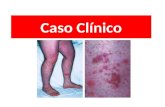 Caso clinico purpura de Schonlein Henoch (Med 2 upao Gianmarco Guzman Castillo)