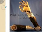 Protesis bionicas