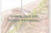 Paralisis del plexo braquial