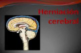 Herniación cerebral
