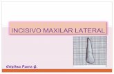 Prostodoncia-  Incisivo Maxilar Lateral