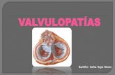 Valvulopatias Fisiopato y semiologia