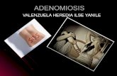 Adenomiosis ilse