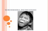 Exerodermia pigmentosa