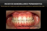 Anatomia dental: Incisivos mandibulares permanentes