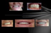 Clínica Doctores López - Estética Dental y Odontología. Antes y después