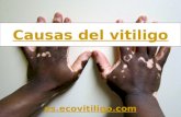 Causas del vitiligo
