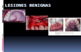 Radiología: Lesiones benignas (En torus palatino)