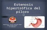 Estenosis hipertrófica del píloro