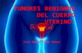Tumores benignos del cuerpo uterino