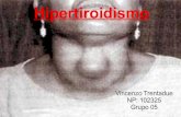 Hipertiroidismo, Bocio