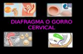 Diafragma o gorro cervical