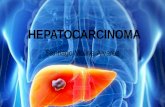 Hepatocarcinoma o cáncer de hígado