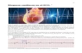 Bloqueos Cardiacos en El ECG