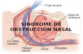 Síndrome de Obstrucción Nasal
