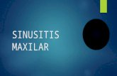 Sinusitis Maxilar