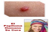 Sintomas Del Papiloma Humano, Sintomas de Papiloma Humano, Virus Papiloma Humano Cura