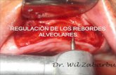 Alveoloplastia y Regulacion de Los Rebordes Alveolares Ppt