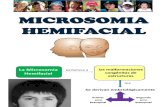 MICROSOMIA HEMIFACIAL