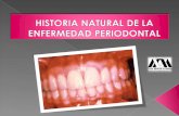 Historia Natural de La Enfermedad Periodontal[1]